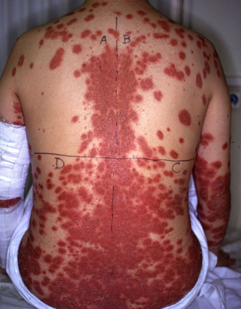 乾癬の症例（背中）