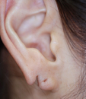 耳垂裂のイメージ